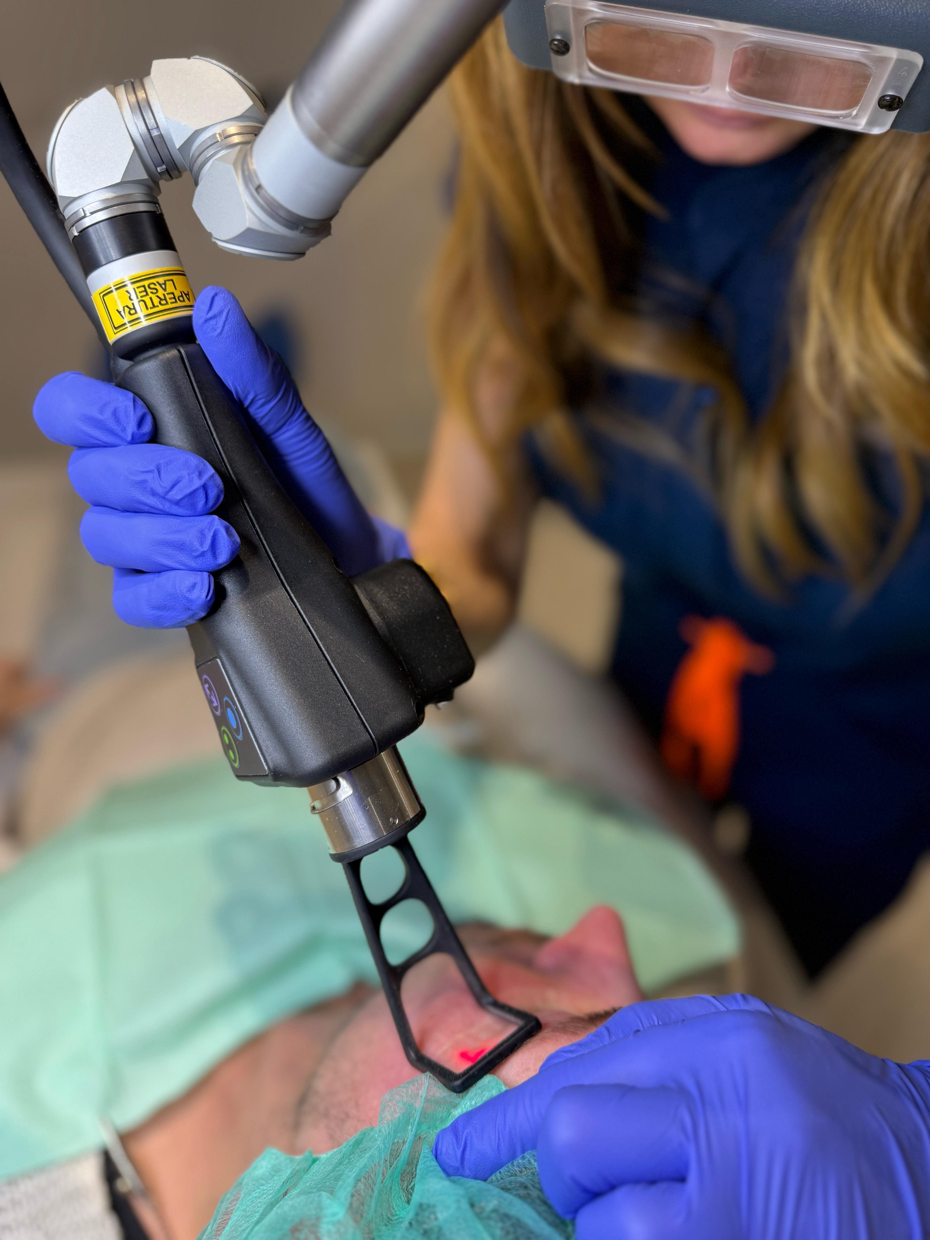 laser co2 frazionato