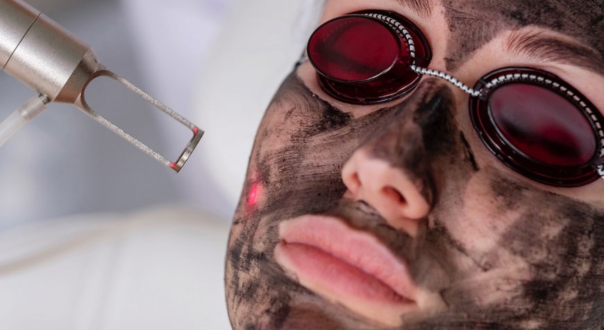 Laser Carbon Peel, il nuovo trattamento laser per rigenerare il viso in modo veloce e sicuro