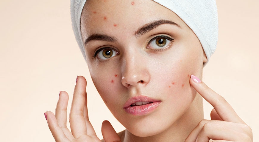 Acne: i cibi che aiutano a prevenirla